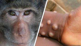 Вспышка обезьяньей оспы может быть результатом провала программы вакцинации против COVID-19