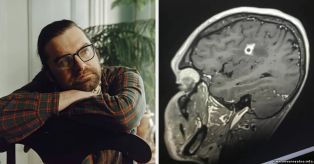 У мужчины в мозгу растет черная плесень — страшное заболевание
